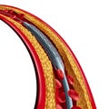 Coronary Stent Placement Isolated Royalty Free Stock Photo