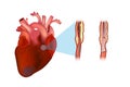 A coronary stent is a tube-shaped device placed in the coronary arteries.