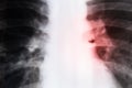 Coronavirus concept. Close-up x-ray of human lungs Royalty Free Stock Photo