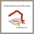 Corpus luteum cyst on the ovary. Functional cyst. Royalty Free Stock Photo