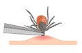 Tick removal