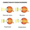 Correction of eye vision disorders by lens.