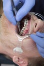 Correction of teeth of a person with an incorrect bite. The installation of braces. Tweezers in the hands of an orthodontist.