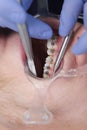 Correction of teeth of a person with an incorrect bite. The installation of braces. Vertical photo. Extender for the mouth