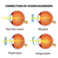 Correction of various eye vision disorder. Royalty Free Stock Photo