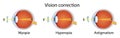Correction of various eye vision disorders by lens. Hyperopia, myopia, astigmatism. Vector illustration