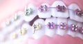 Cosmetic dental metal brackets Royalty Free Stock Photo