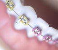 Cosmetic dental metal brackets Royalty Free Stock Photo