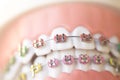 Cosmetic dental metal brackets Royalty Free Stock Photo