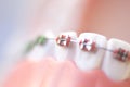 Cosmetic dental metal brackets Royalty Free Stock Photo