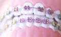 Cosmetic dental metal brackets