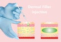 Cosmetic filler or dermal fillers