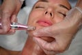 Anti-aging care with dermapen, patient face close-up Royalty Free Stock Photo