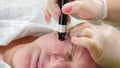 Cosmetologist curing rosacea or couperosis with modern laser technology in beauty clinic, doctor using highly efficient