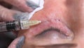 Cosmetologist doctor making multiple injections biorevitalization in woman face skin under eye, closeup shot