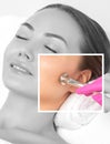 Cosmetologist makes procedure microdermabrasion on the face against acne and blackheads near the eyes.