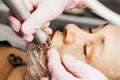 Cosmetologist performs laser rejuvenation procedure. CO2 Fractional Laser