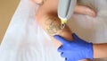 The cosmetologist removes the tattoo on the leg of a young pretty girl with a laser.