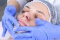 Cosmetologist wipes the face of a young woman with cotton pads. Hands of the beautician in gloves and a face closeup