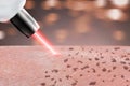 Cosmetology procedure laser freckle skin removal on body parts.