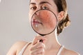 Cosmetology and rosacea. A young woman holds a magnifying glass near her face, showing the inflamed skin of her cheeks with