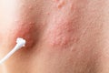 cotton swab treatment of skin rash. Shingles, varicella-zoster virus. skin rash and blisters on body. Skin infected Royalty Free Stock Photo