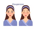 Couperose.Skin disease on beautiful face. Treatment. Woman with open eyes and closed.