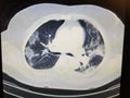 COVID-19 CT Scan of the Chest - black, white