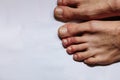 COVID toes . Another another symptom of coronavirus infection. Painful red and purple bumps that tend to occur at the tips of the
