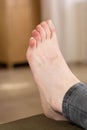 Covid toes. Coronavirus symptoms - swelling and discoloration, purplish color, pain and rough skin Royalty Free Stock Photo