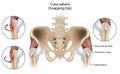 Coxa Saltans or Snapping Hip Snapping Hip Syndrome also referred to as dancer hip. Royalty Free Stock Photo