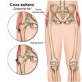 Coxa saltans syndrome 3d medical illustration on white background