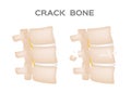 Crack bone spine / broken and damaged disc 