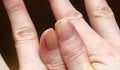 Cracked fingernails close up