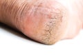 Cracked heel on isoleted background. Royalty Free Stock Photo