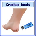 Cracked heels. Foot diseases. Dermatology.