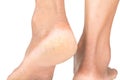 Cracked heels Skin cracks, skin problems Royalty Free Stock Photo