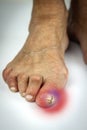 Cracked toe and bunion deformity Royalty Free Stock Photo