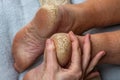 Cracks on the heels of a person& x27;s foot, foot health problems, neglected heel of a person. A doctor examines a Royalty Free Stock Photo