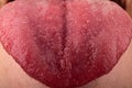 cracks in the tongue Candida diseases, red tongue stomatitis closeup