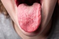 Cracks in the tongue. Candidiasis. Congenital pathology.
