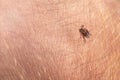 Crawling deer tick on the background of human hairy skin. Infection through the bite of a dangerous insect with a disease. the