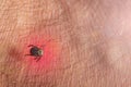 Crawling deer tick on the background of human hairy skin