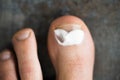 Cream Again Fungus Foot Toenail Infection