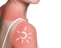 Cream on the shoulder of woman with sunburn Royalty Free Stock Photo