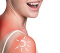 Cream on the shoulder of woman with sunburn Royalty Free Stock Photo