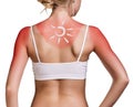 Cream on the shoulder of woman with sunburn