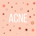 Creative illustration types of acne, pimples, skin pores, blackhead, whitehead, scar, comedone, stages diagram  on Royalty Free Stock Photo