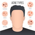 Creative illustration types of acne, pimples, skin pores, blackhead, whitehead, scar, comedone, stages diagram isolated on