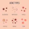 Creative illustration types of acne, pimples, skin pores, blackhead, whitehead, scar, comedone, stages diagram isolated on Royalty Free Stock Photo
